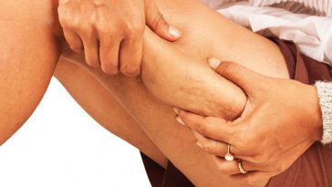 how to reduce thigh fat